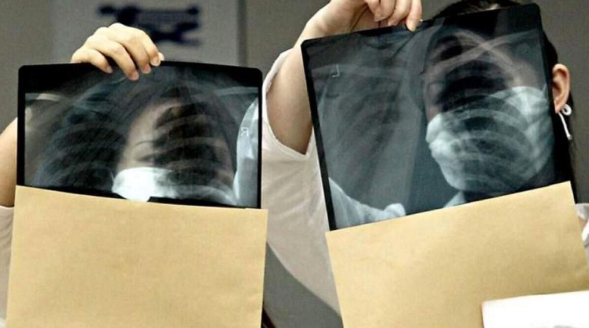 UAE Health ministry supports global efforts to end tuberculosis by 2030