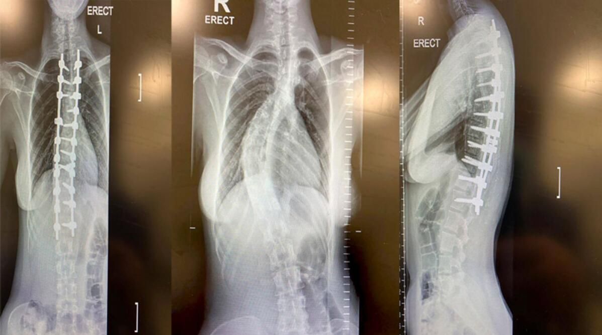 أبو ظبي: الأطباء يجرون عمليات جراحية معقدة لتقوّس العمود الفقري المنحني